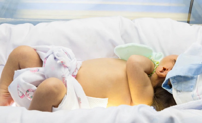درمان خانگی زردی نوزاد در طب سنتی